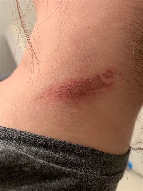 The imprint of CONAIR from my friend’s curling iron burn. : r ...