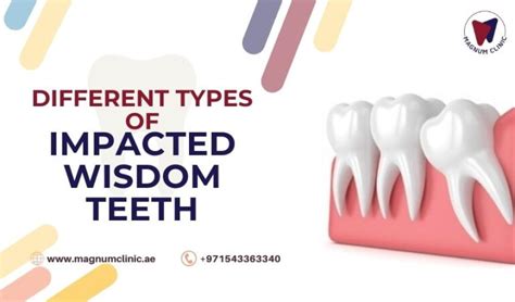 Image result for Wisdom Teeth Impaction Types
