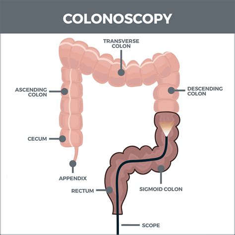 A Colonoscopy Procedure 的图像结果