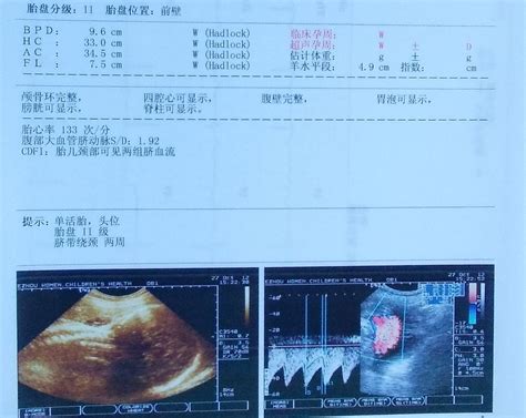 怀孕34周，宝宝脐带绕颈一周，医生：放宽心，他会自己绕出来 - 知乎