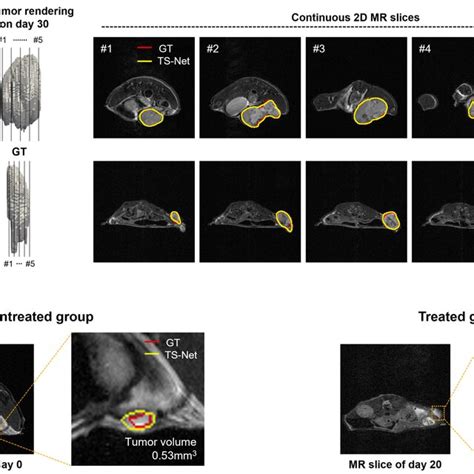 Image result for Tumor Segmentation Using Python