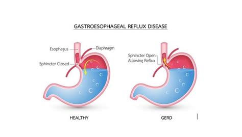 GERD - Gejala, Penyebab, dan Pengobatan - Alodokter