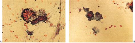 Serrated Polyps | Abdominal Key