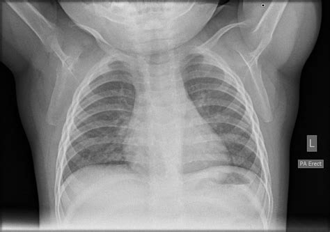 Normal Chest X Ray Images