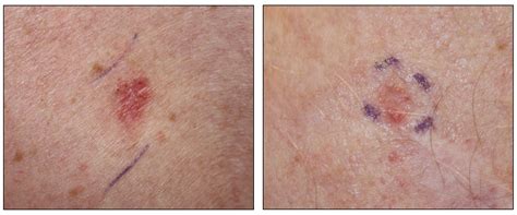 Superficial Basal Cell Carcinoma Early Stages