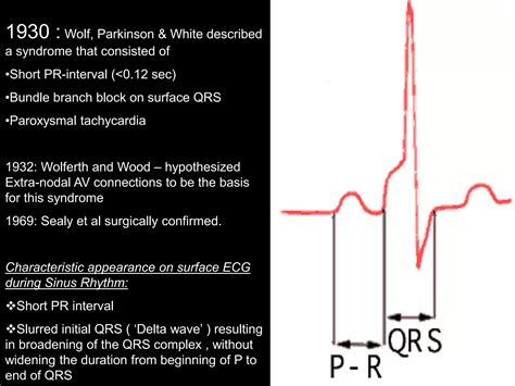 Pre-excitation Syndromes.ppt