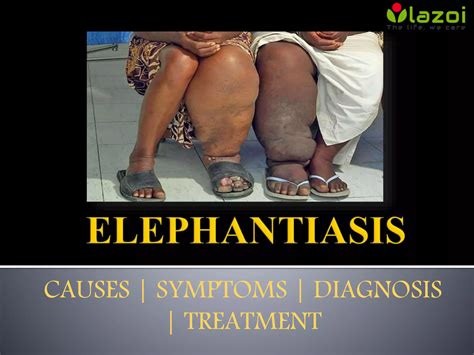 Elephantiasis : causes, symptoms, diagnosis and treatment | PPTX