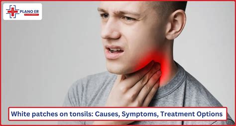 White Spots On Tonsils Thrush