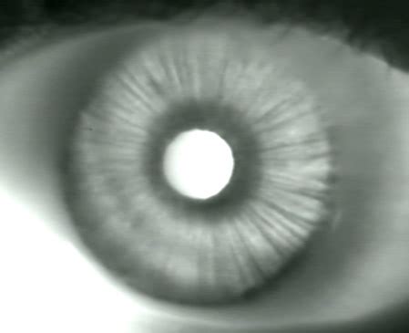 Image result for Transillumination Normal Head