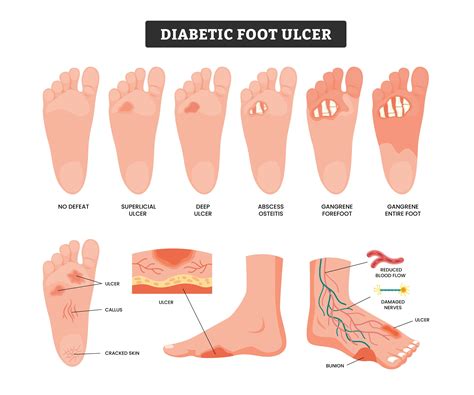 Diabetic Foot Wounds