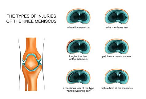 Meniscus Pain Symptoms