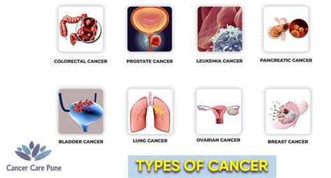 Types of Cancer Names 的图像结果