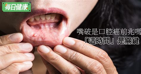 口腔癌4大早期症狀大揭密？「嘴破」整個月要小心 - 每日健康