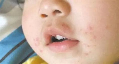 宝宝嘴巴周围起红疹是怎么回事？可能是4个原因在作怪！ - 知乎