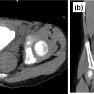 Image result for Cystogram Procedure for CT Scan