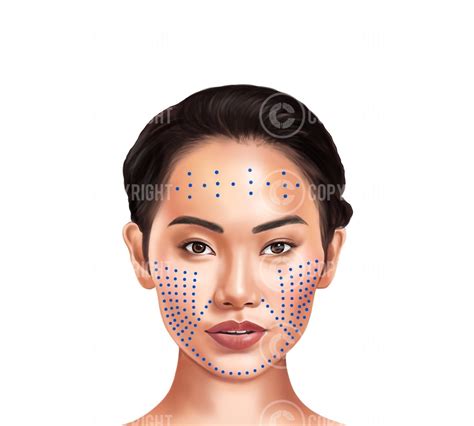 Image result for Botox Injection Patterns