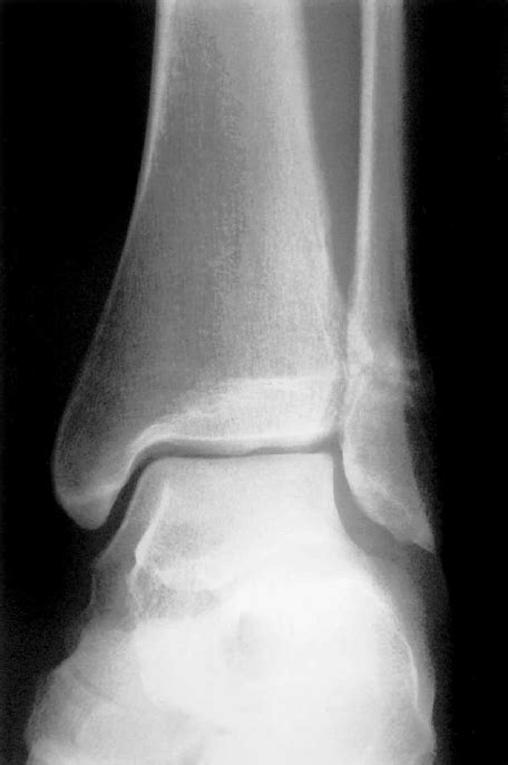 Radiograph of left ankle showing the fracture of the distal fibula ...