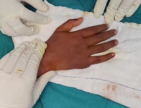 Successful Surgery