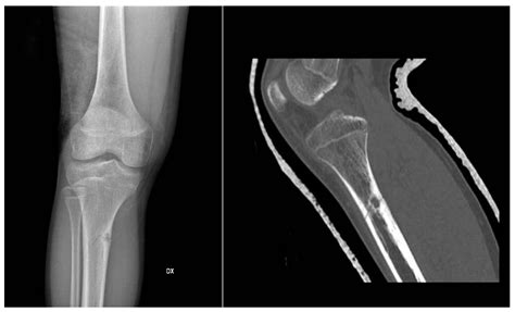Benign Bone Tumors: An Overview of What We Know Today
