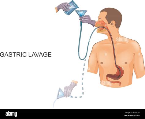 vector illustration of gastric lavage with a gastric tube Stock Vector ...