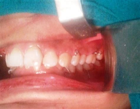 Image result for Transnasal Loop Fixation