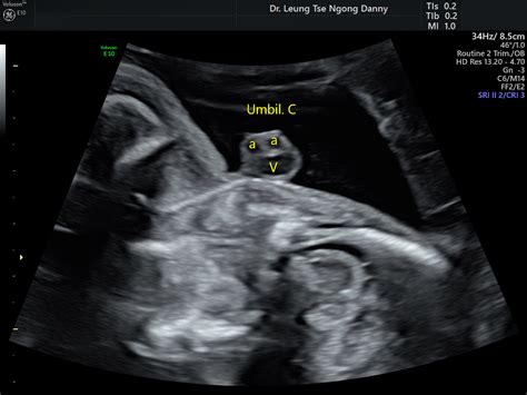 Bildergebnis für normal umbilical cord ultrasound