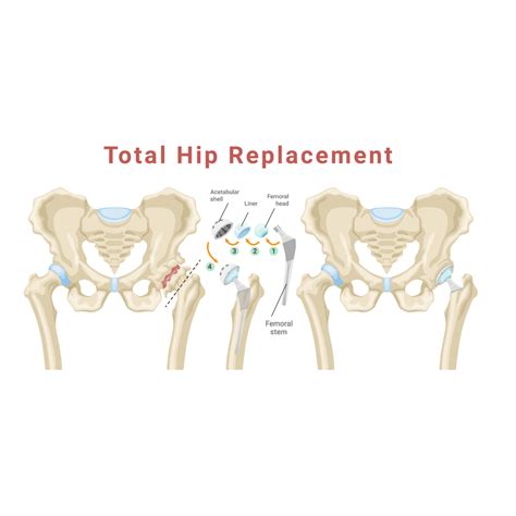Hip Replacement (Total/Partial) - Dr. Savla