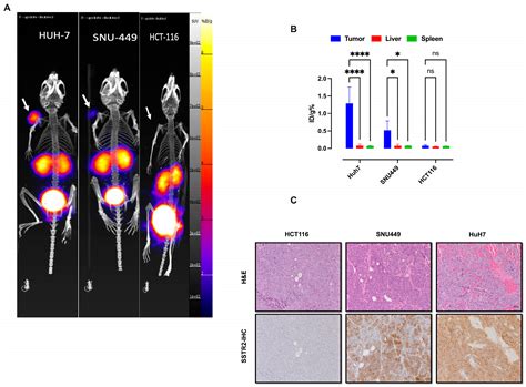SSTR2-Targeted Theranostics in Hepatocellular Carcinoma
