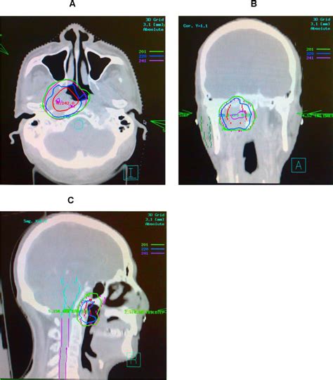 CT Simulation Procedure 的图像结果