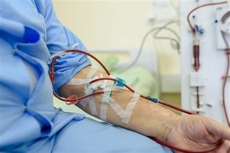 Dpr Dialysis Fistula Complications