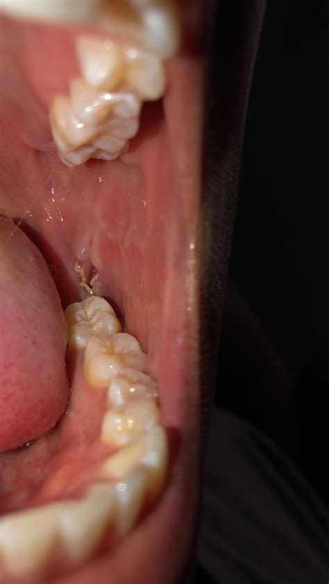 After Wisdom Teeth Removal Stitches