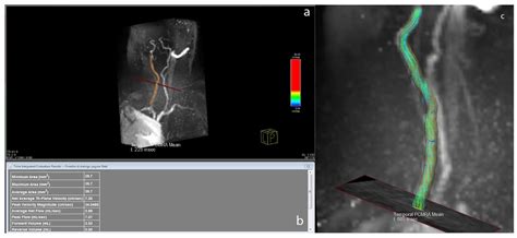 Carotid Phase-Contrast Magnetic Resonance before Treatment: 4D-Flow ...