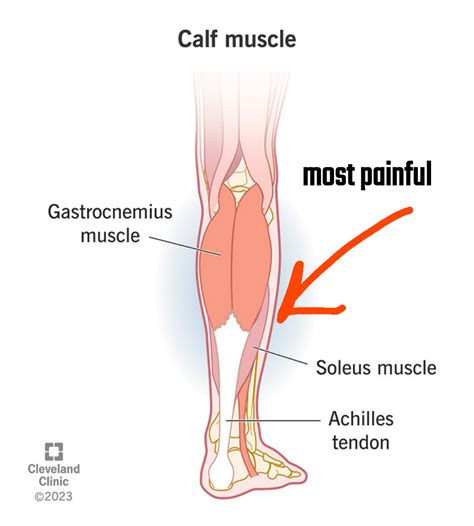 Pulled Calf Muscle Treatment