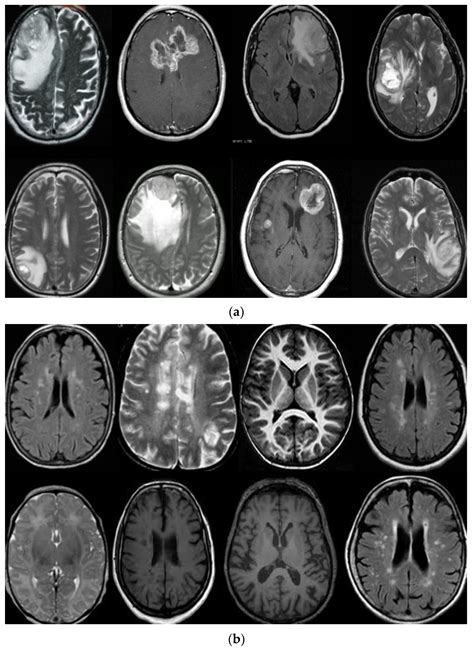 Brain Mri Tumor