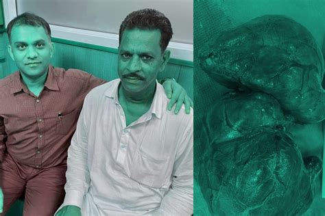 Doctors Save Farmer’s Life, Remove ‘Monster’ Tumor From His Thyroid THE ...