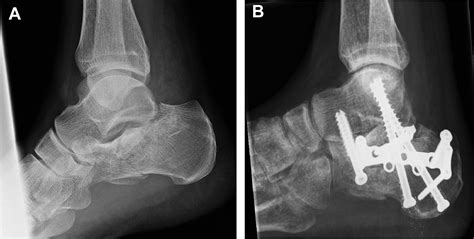 Fixation by Open Reduction and Internal Fixation or Primary Arthrodesis ...