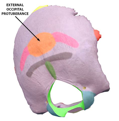 VB News Desk: Horns?! Nope, just an enlarged external occipital ...