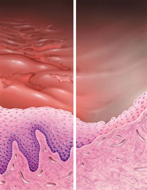 Pictures Of Atrophic Vulvovaginitis