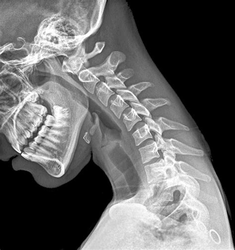 X Ray Of Spine Bone Cancer infection, bone tumors, endocrine, metabolic - radiology flashcards ...