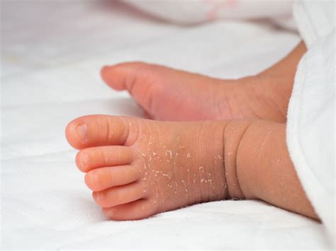 Why Your Newborn's Skin Is Peeling