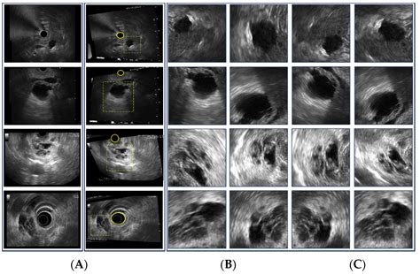 Deep Learning-Based Differentiation between Mucinous Cystic Neoplasm ...