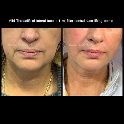 PDO thread lift - Vista Clinic Melbourne Australia