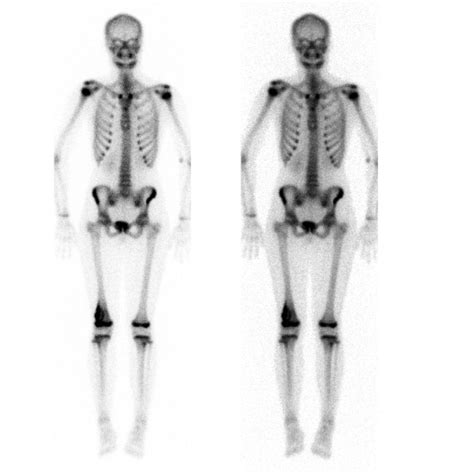 Osteosarcoma x ray - wikidoc