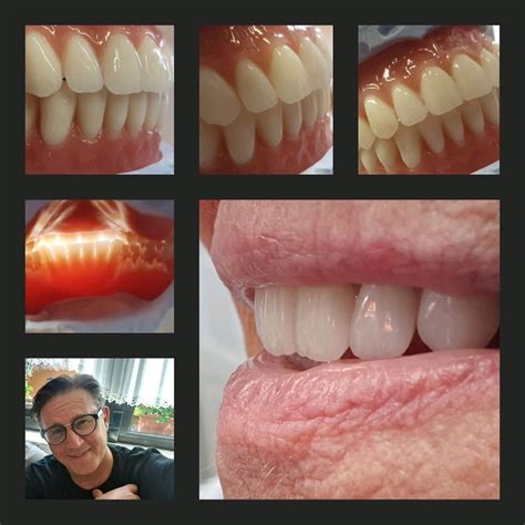 Onofrio Azzaretto on LinkedIn: upper and lower reconstruction with full ...