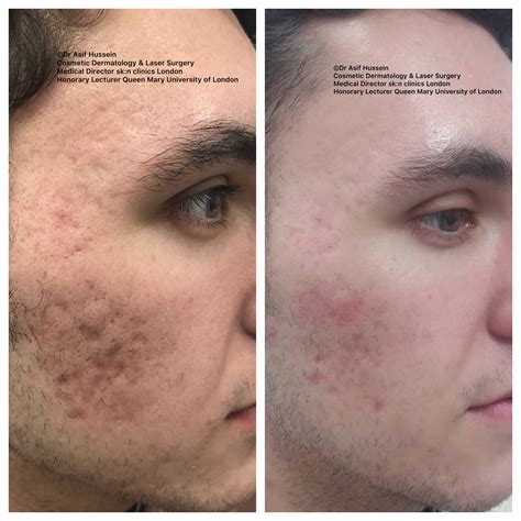 Acne Scar Laser Treatment & Removal London | Dr H Consult