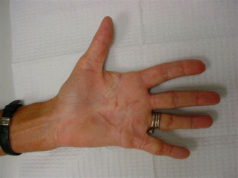 Image result for Hand Dysfunction