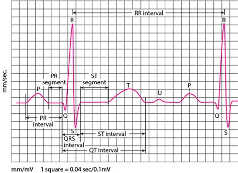 Electrocardiography - Electrocardiography - MSD Manual Professional Edition