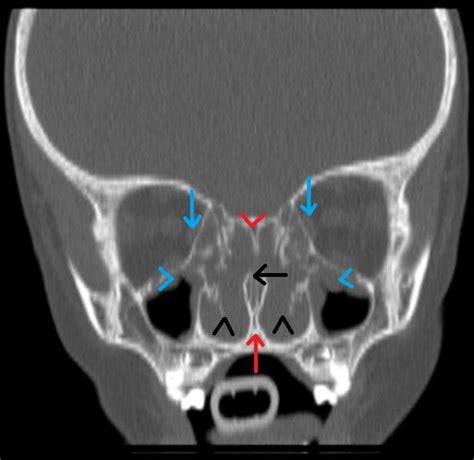Inferior turbinate hypertrophy presenting as bilateral nasal masses in a paediatric patient ...