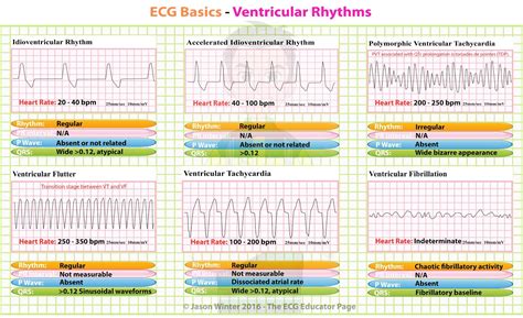 Basic ECG Rhythms 的图像结果