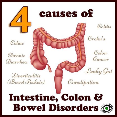 diverticulitis and constipation